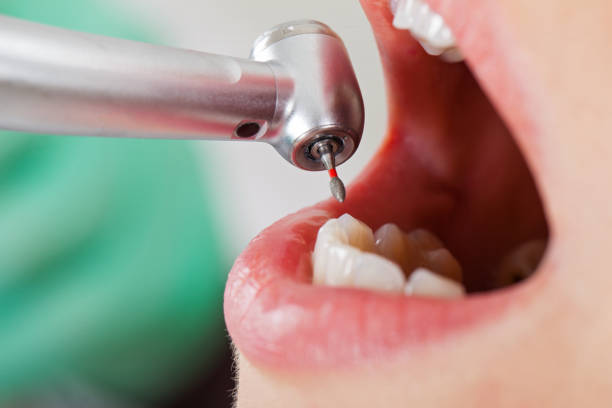 Best Emergency Wisdom Teeth Removal in Brandenburg, KY